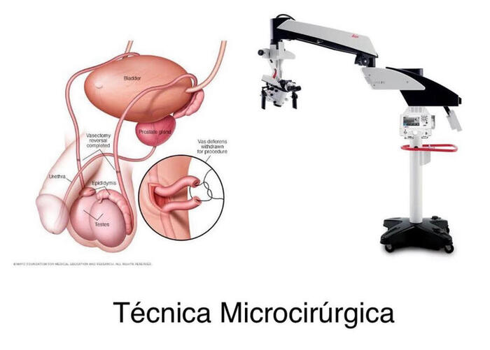 Ilustração técnica da reversão de vasectomia — vasovasostomia microcirúrgica